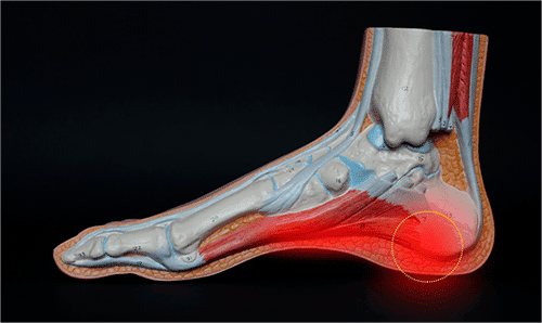 Fascitis plantar roll